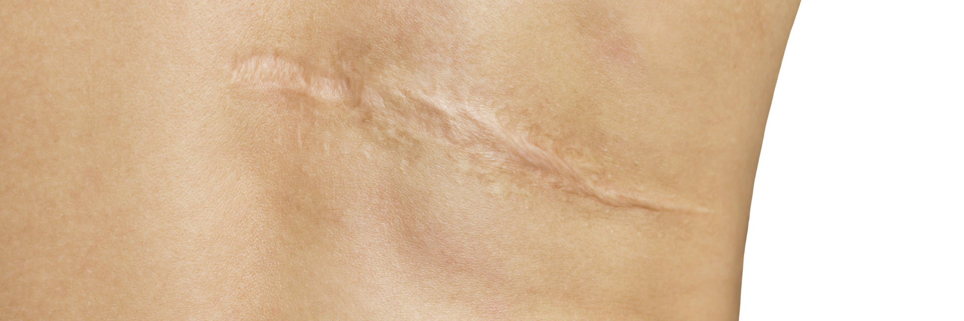 Keloid Scars Beverly Hills, CA