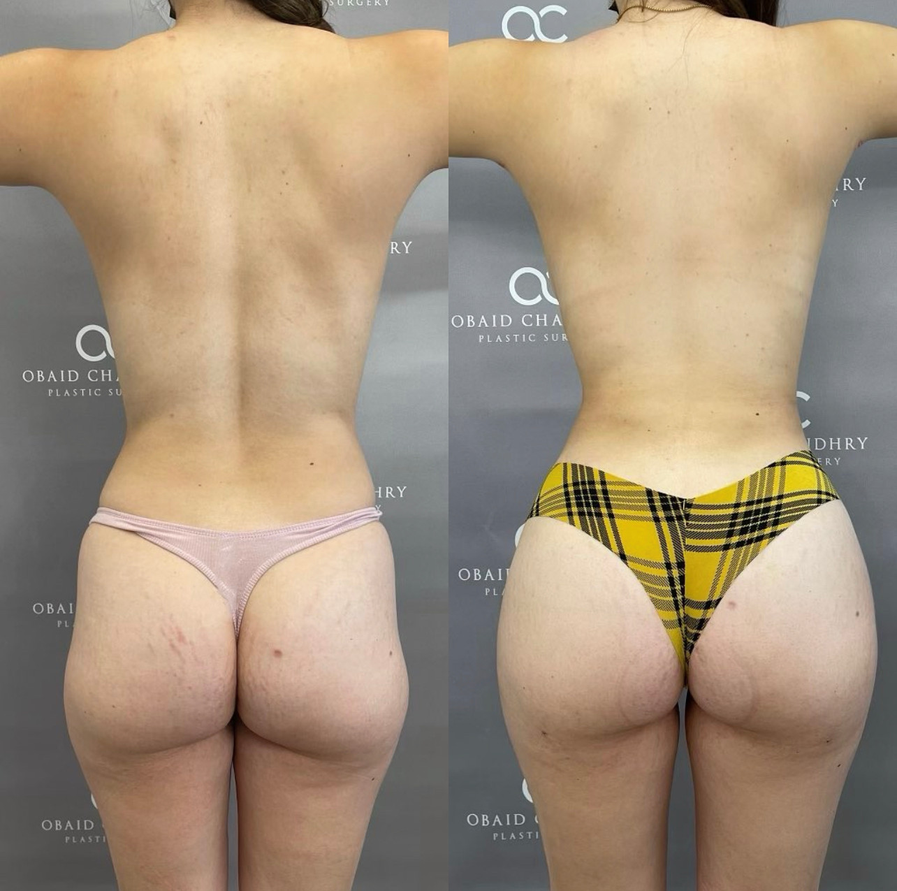 Laser Liposuction BBL Before and After