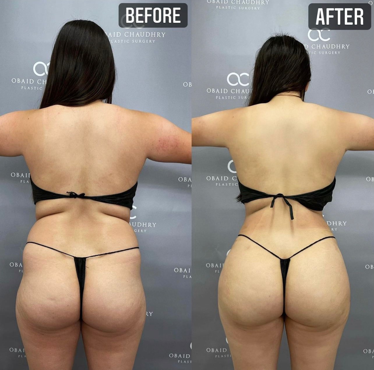 Laser Liposuction BBL Before and After